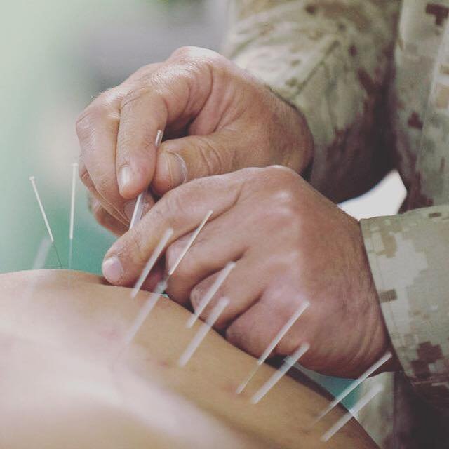 Acupuncture & Injury